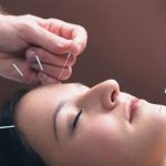 facial acupuncture