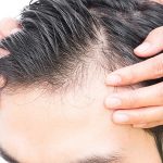 Hair transplantation cost in Jaipur